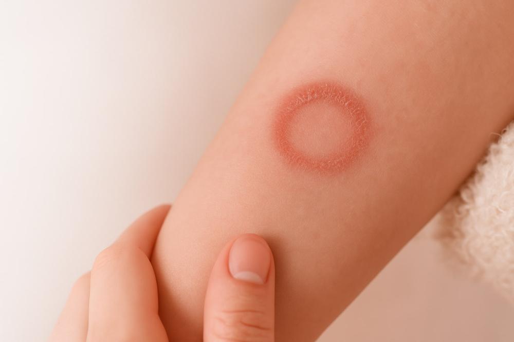 Skin Infections