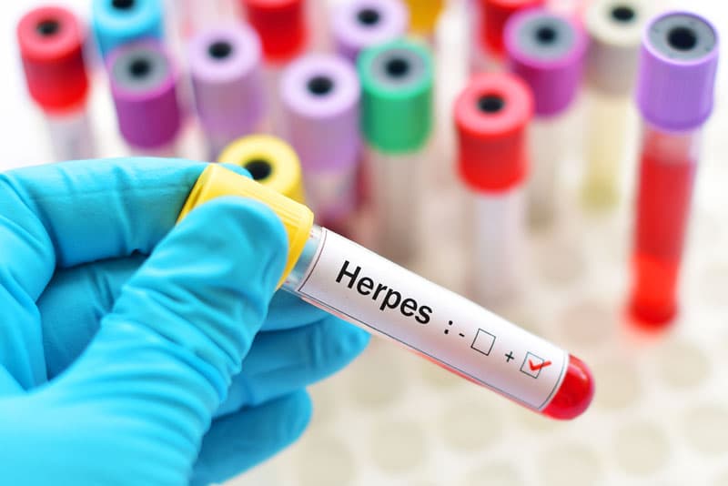 Herpes in a test tube