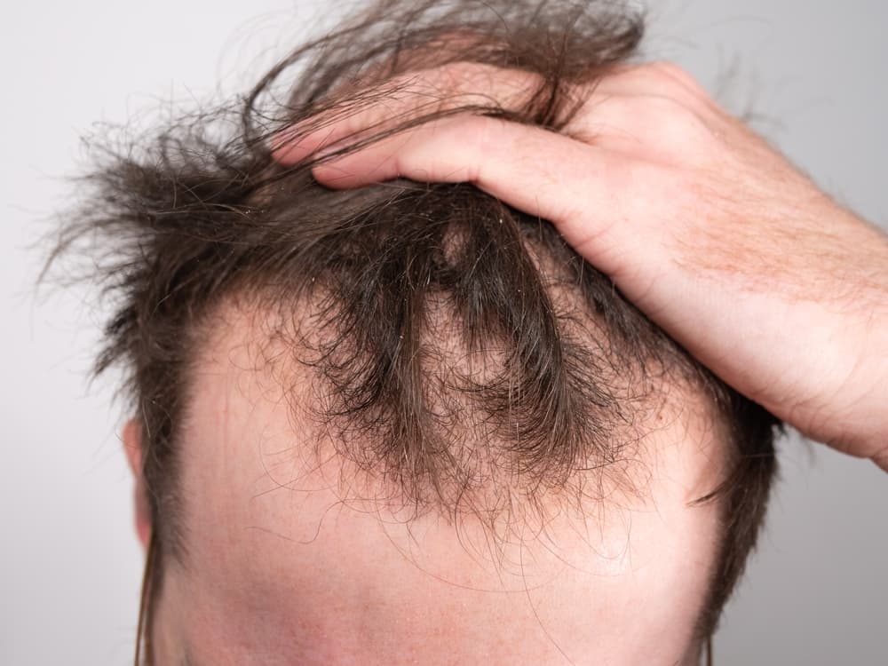 A man lifting up the hair on his head to reveal a receding hairline