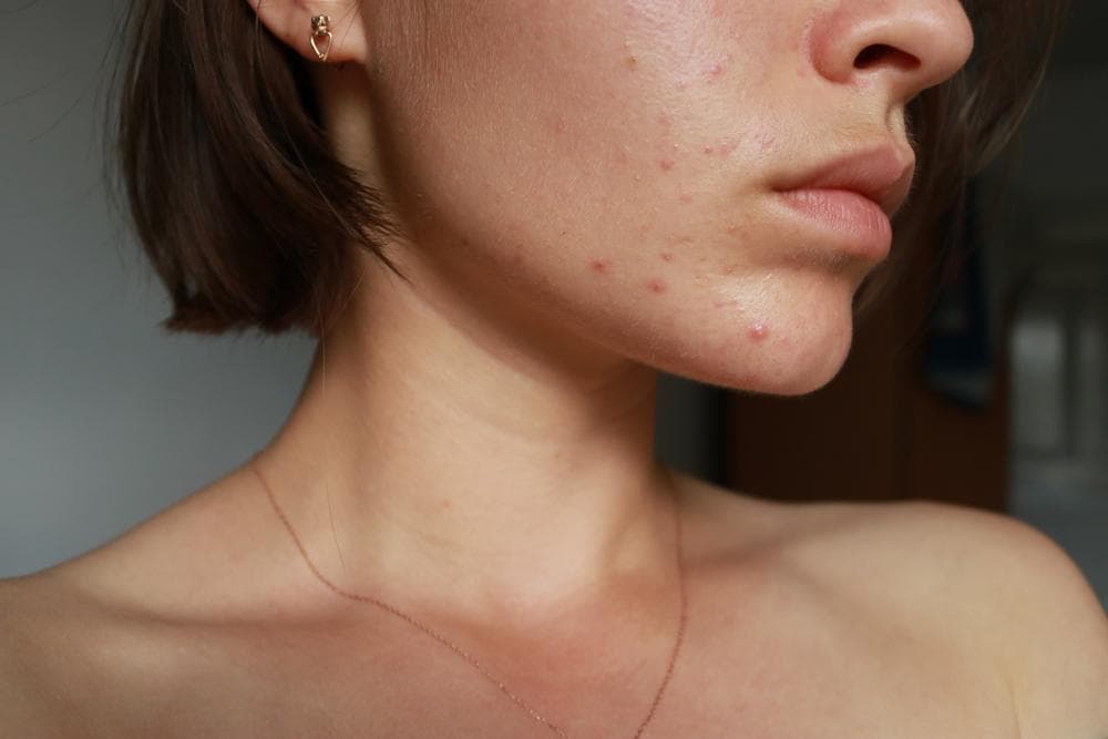 A lady with acne on her face