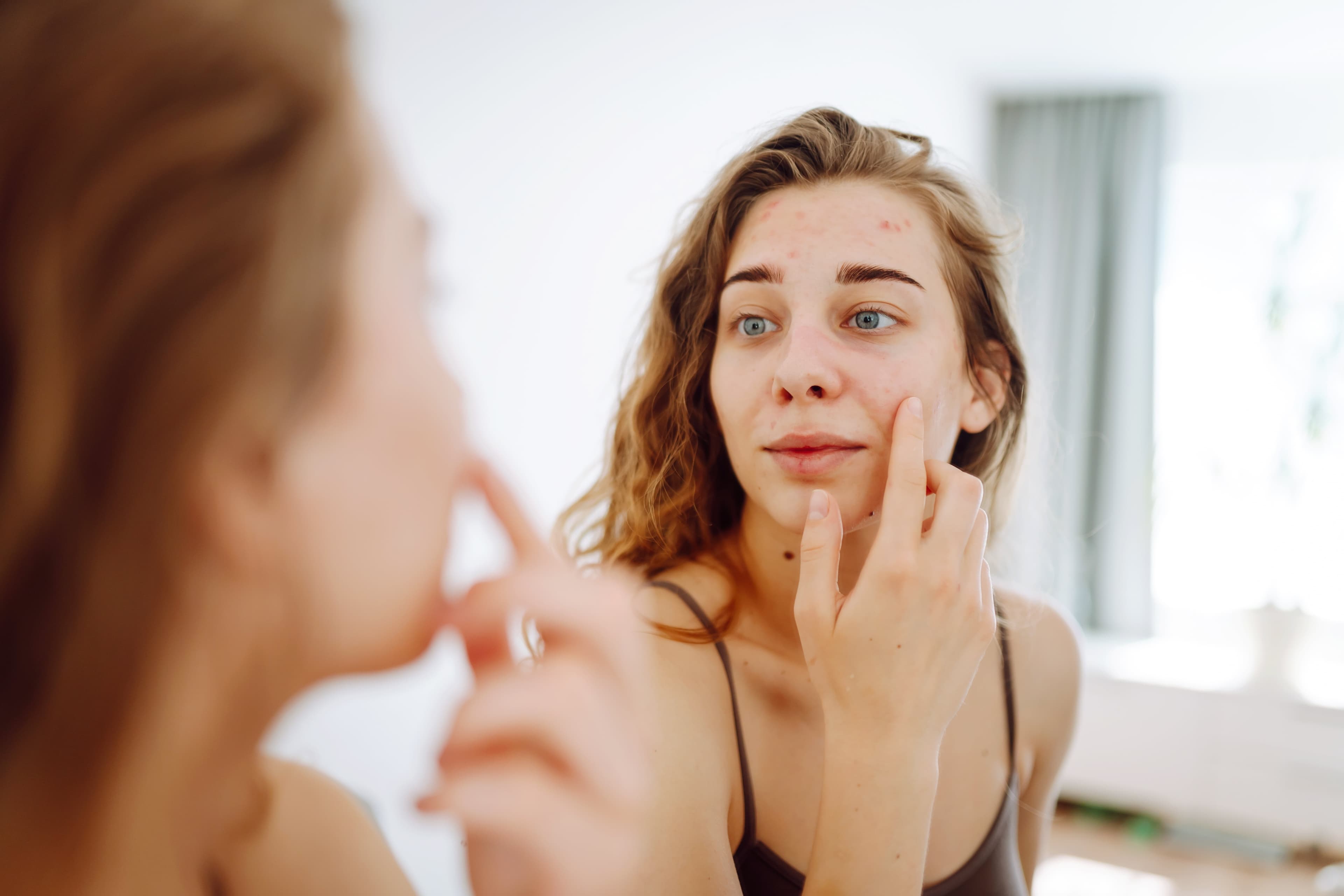 A lady assessing her facial acne in the mirror