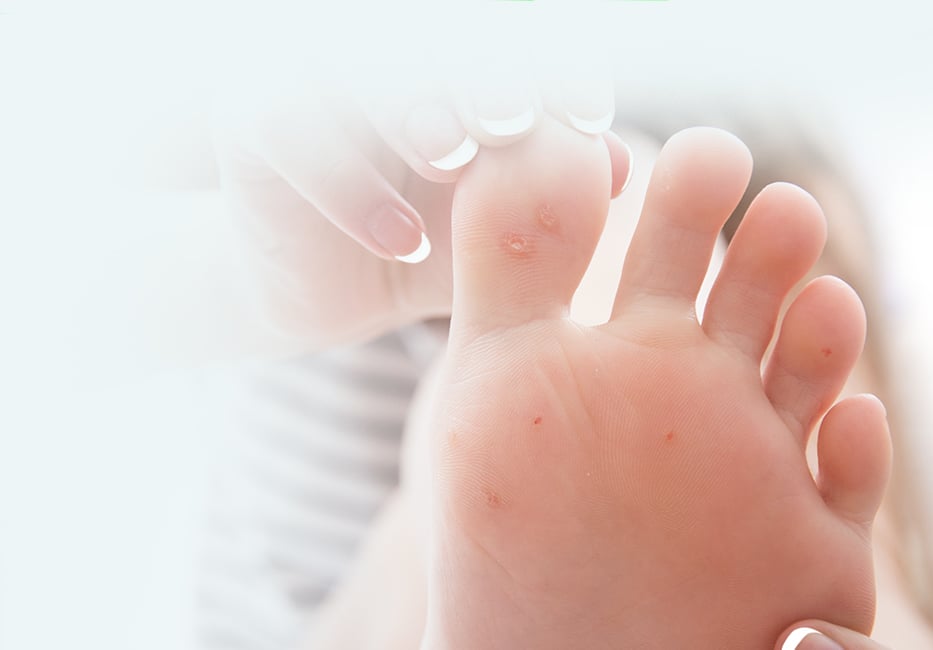 Warts & Verruca Treatment
